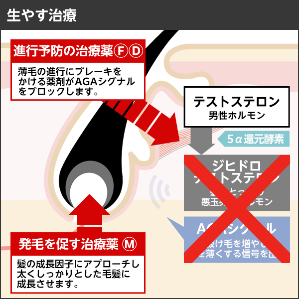 生やすAGA治療の図説　生やすAGA治療とは内服薬ⓜミノキシジルを服用することで毛乳頭に作用する成長因子の分泌を促し毛母細胞を活性化する作用、そして血行を改善しより多くの酸素と栄養を毛根へ届ける作用の２つの働きにより健やかな髪の成長を助け、その結果として髪を生やす発毛が期待できる治療です。