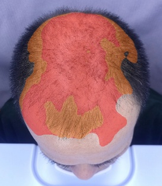 頭頂部画像