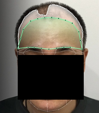 前額部画像