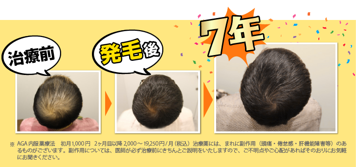 治療前・発毛後・7年後のAGA治療の症例