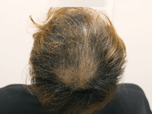AGA治療の効果と実績・症例（ビフォア・アフター症例写真） | AGA