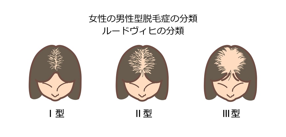FAGA（女性男性型脱毛症）のルードヴィヒ分類（Ludwig Classification scale）