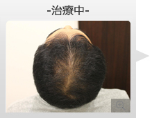 40代男性 AGA内服薬治療 治療中（症例写真）