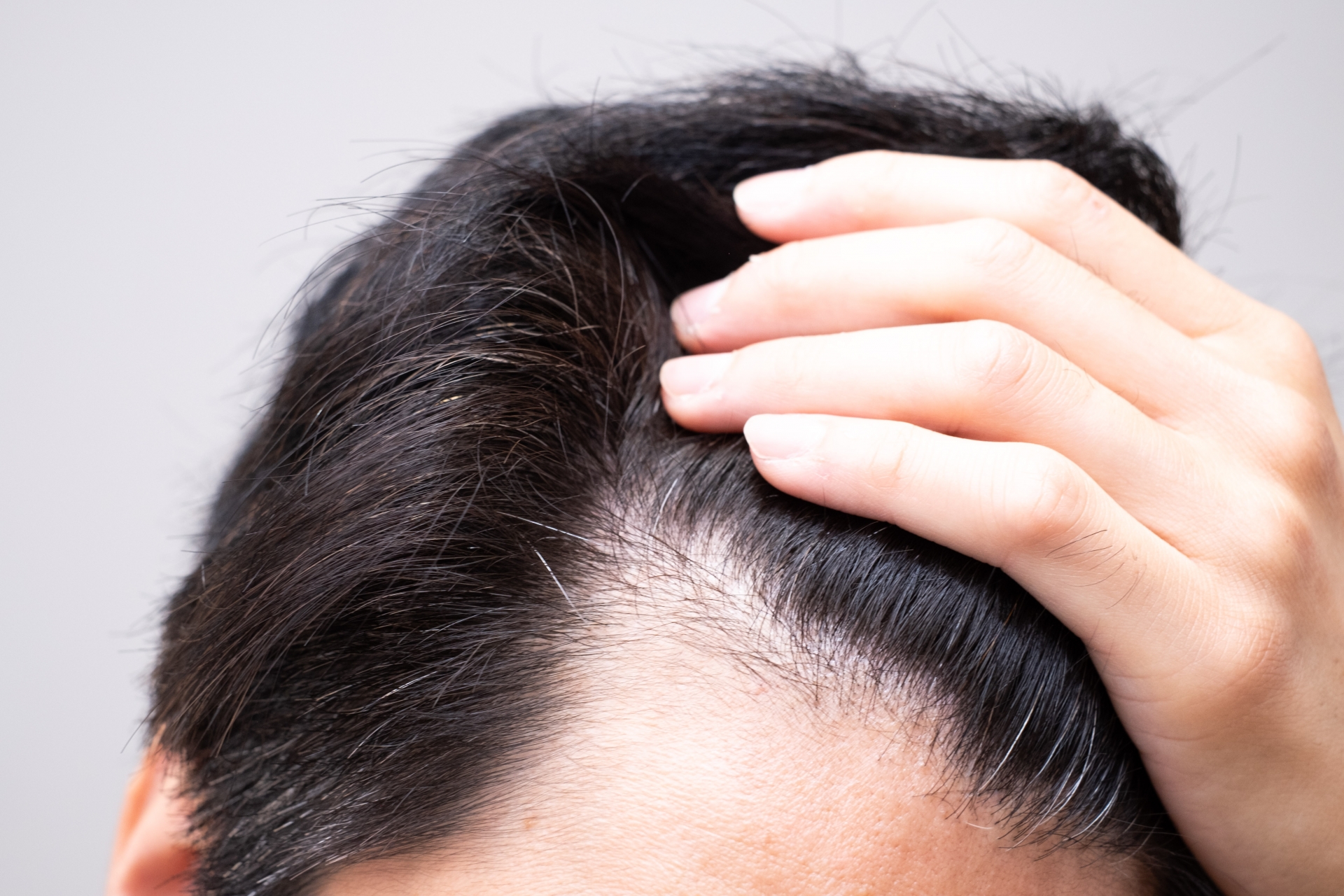 薄毛の対策方法は何がある？薄毛の原因や予防法まで解説【医師監修】